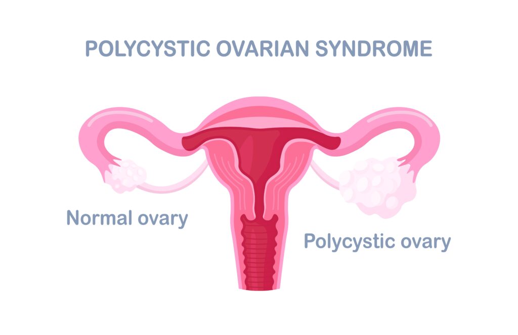 pcos and its causes, symptoms, treatment and management
