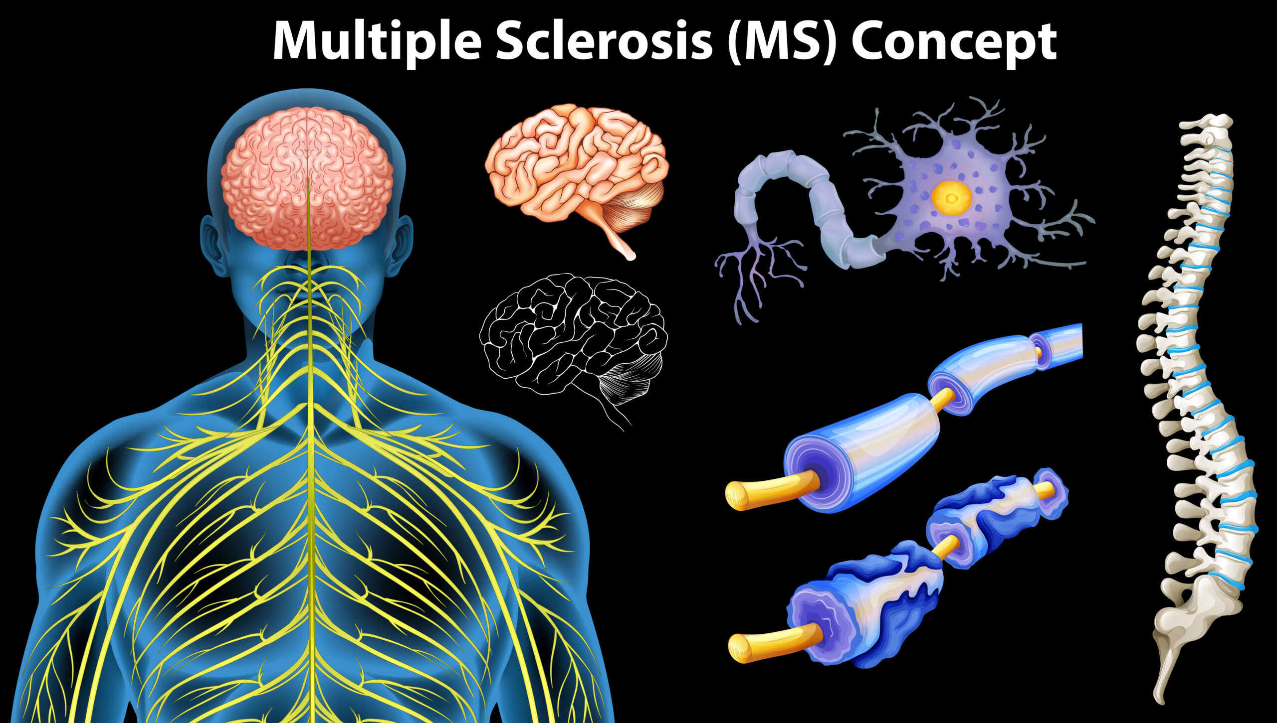 Multiple Sclerosis (MS) Awareness: Understanding the Impact and Management