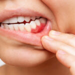 diabetic mouth ulcers and sores