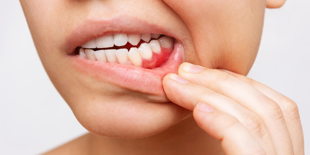 A Comprehensive Guide on Caring for Diabetic Ulcers and Sores in the Mouth