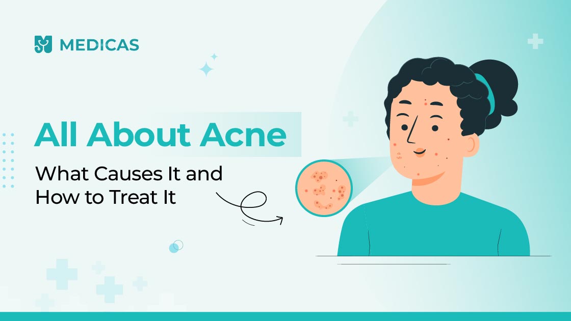 acne treatment